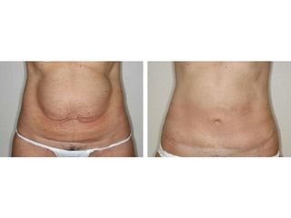 Abdominoplastia - Dr. Ramón Vila-Rovira
