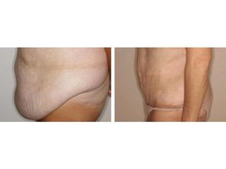 Abdominoplastia - Dr. Ramón Vila-Rovira