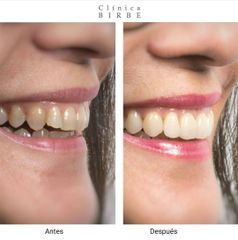 Antes y después Carillas dentales