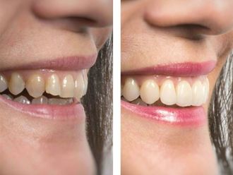 Carillas dentales - 646525