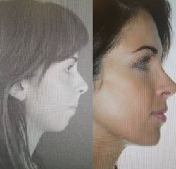 Antes y después Cirugia ortognatica