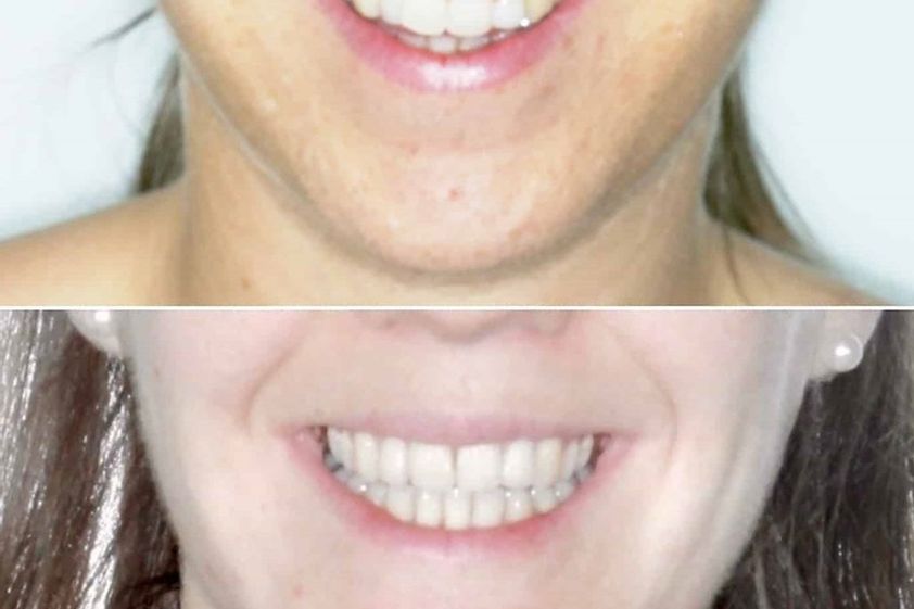Cirugía maxilofacial antes y después - 647241
