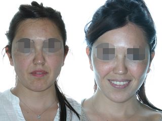 Antes y después Rinoplastia y lifting facial