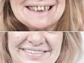 Carillas dentales - 648501