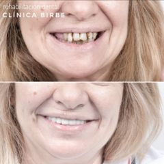 Antes y después Rehabilitación oral