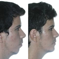 Antes y después Cirugía maxilofacial