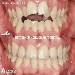 Antes y después Ortodoncia 