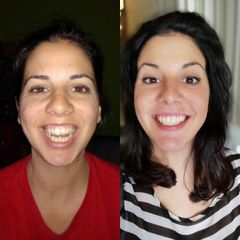 Antes y después Cirugía maxilofacial 