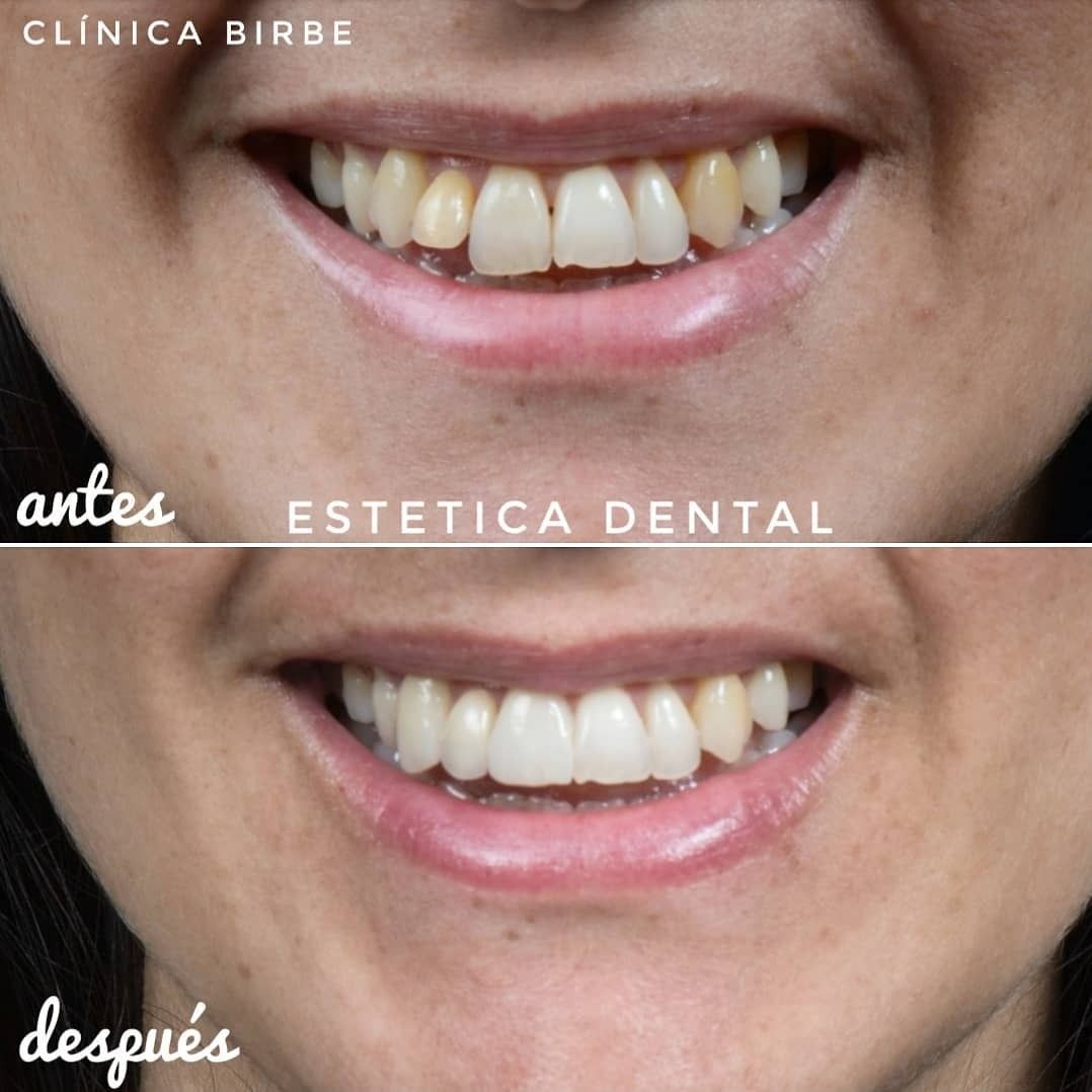 Lifting de labios, lifting facial y lifting de párpados superiores -  Carolina Facial Plastics