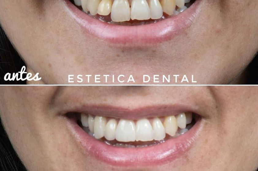 Blanqueamiento dental antes y después - 738533