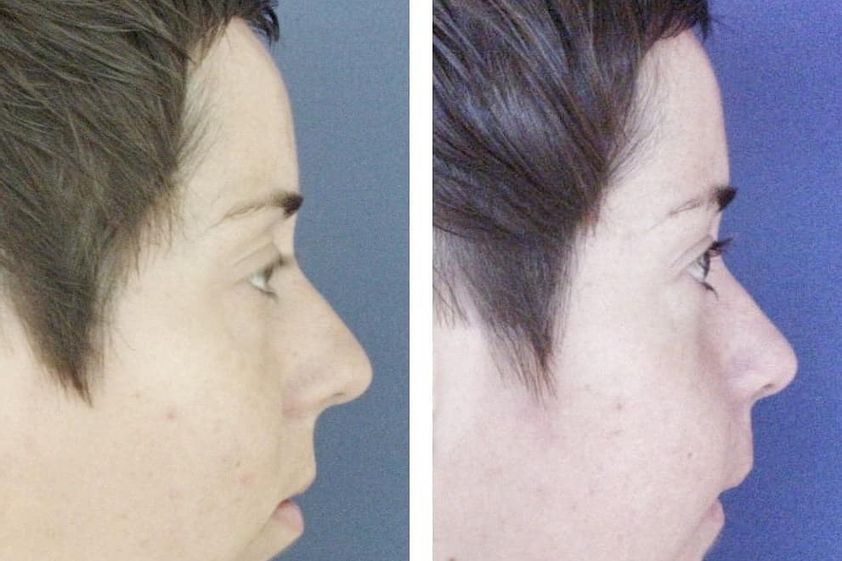 Cirugía maxilofacial antes y después - 738534