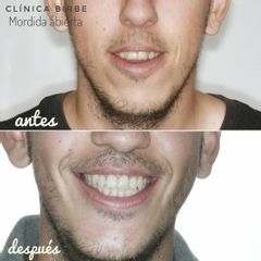 Antes y después Ortodoncia 