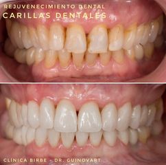 Blanqueamiento dental - Clínica Birbe
