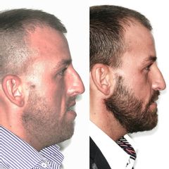 Antes y después Cirugía maxilofacial 