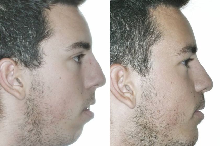 Cirugía maxilofacial antes y después - 738543