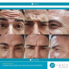 botox en hombres Dra Sánchez De Gea | Solesio Clinic