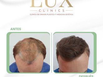 Trasplantes capilares antes y después - 876461