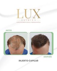 Lux Clinics - Transplante capilar