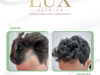 Tratamiento capilar antes y después - 876462