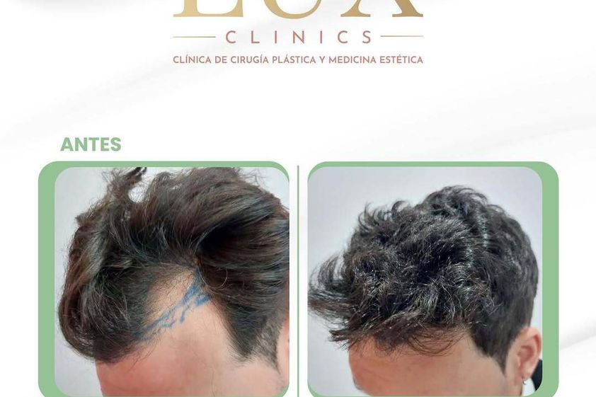Tratamiento capilar antes y después - 876462