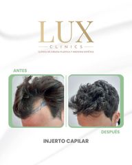 Lux Clinics - Transplante Capilar