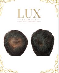 Lux Clinics - Transplante Capilar