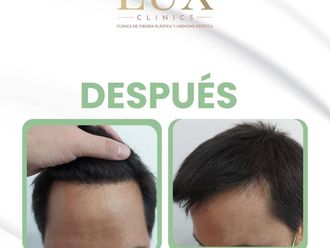 Trasplantes capilares antes y después - 876464