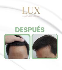 Lux Clinics - Transplante capilar