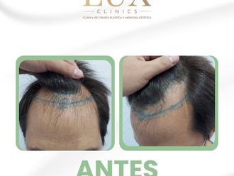 Trasplantes capilares antes y después - 876465