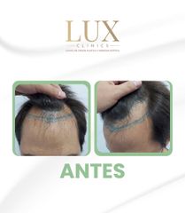 Lux Clinics - Transplante capilar