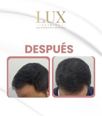 Lux Clinics - Transplante capilar