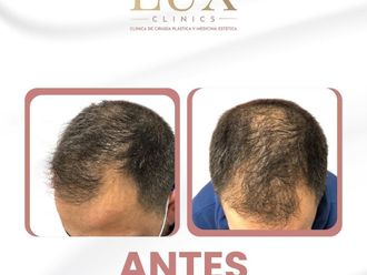 Trasplantes capilares antes y después - 876467