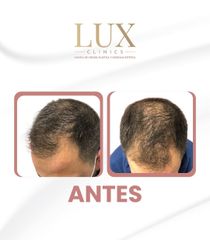 Lux Clinics - Transplante capilar