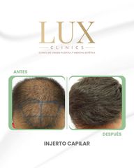 Lux Clinics - Injerto Capilar
