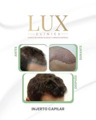 Lux Clinics - Transplante Capilar