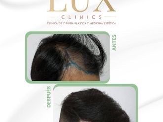 Trasplantes capilares antes y después - 876470