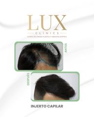 Lux Clinics - Transplanta capilar