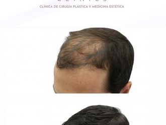 Trasplantes capilares antes y después - 876471