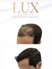 Lux Clinics - Transplante Capilares