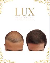Lux Clinics - Transplante Capilares