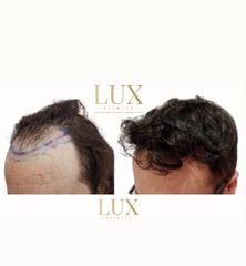 Lux Clinics - Transplantes Capilares