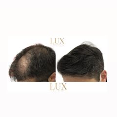 Lux Clinics - Transplante Capilar