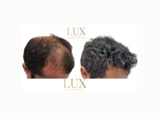 Lux Clinics - Transplante Capilares