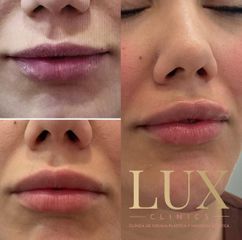 Lux Clinics - Ácido Hialurónico