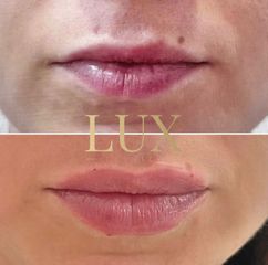 Lux Clinics - Ácido Hialurónico