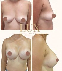 Lux Clinics - Aumento de pecho