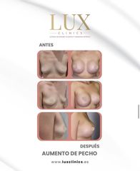 Lux Clinics - Aumento de pecho