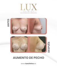 Lux Clinics - Aumento de pecho