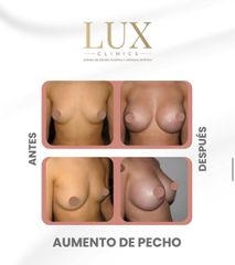 Lux Clinics - Aumento de pecho