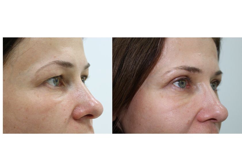 Blefaroplastia antes y después - 410743